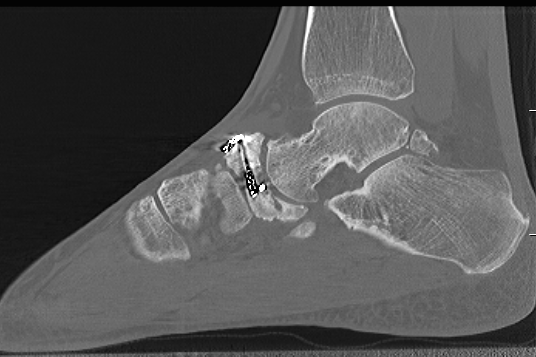 Navicular ORIF 2